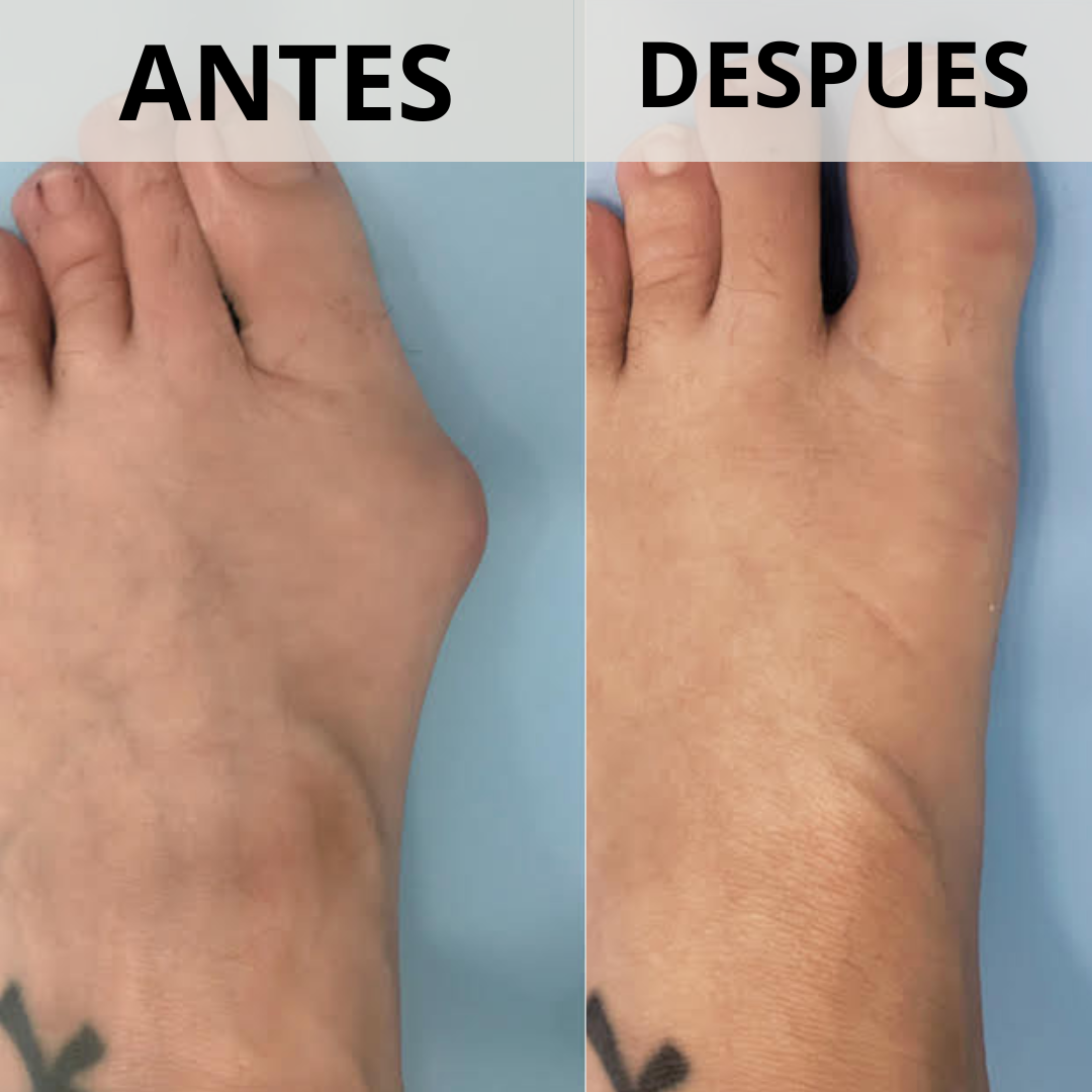 Corrector de Juanetes con perilla de ajuste