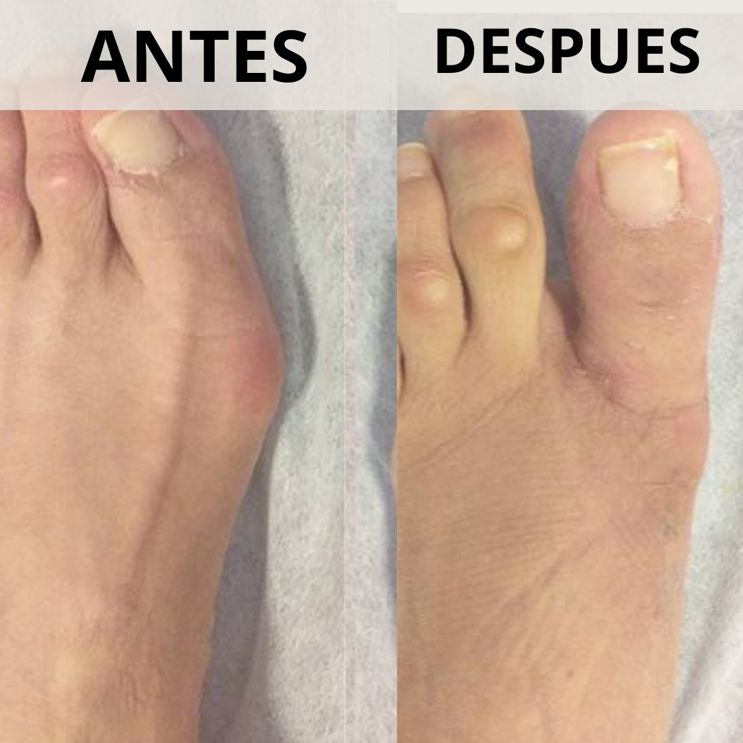 Corrector de Juanetes con perilla de ajuste