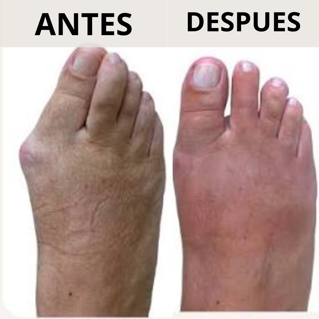 Corrector de Juanetes con perilla de ajuste