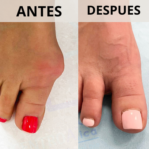 Corrector de Juanetes con perilla de ajuste