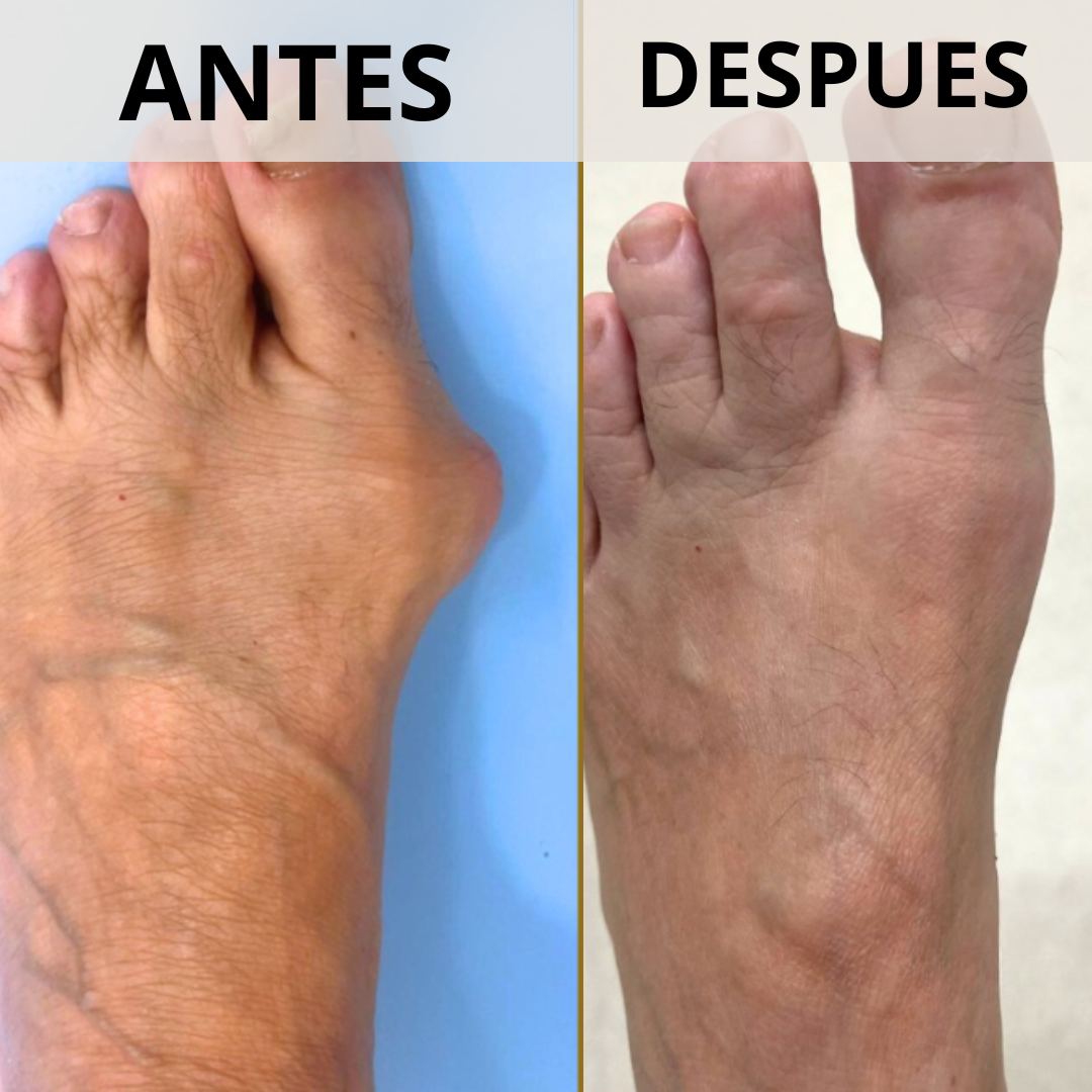Corrector de Juanetes con perilla de ajuste