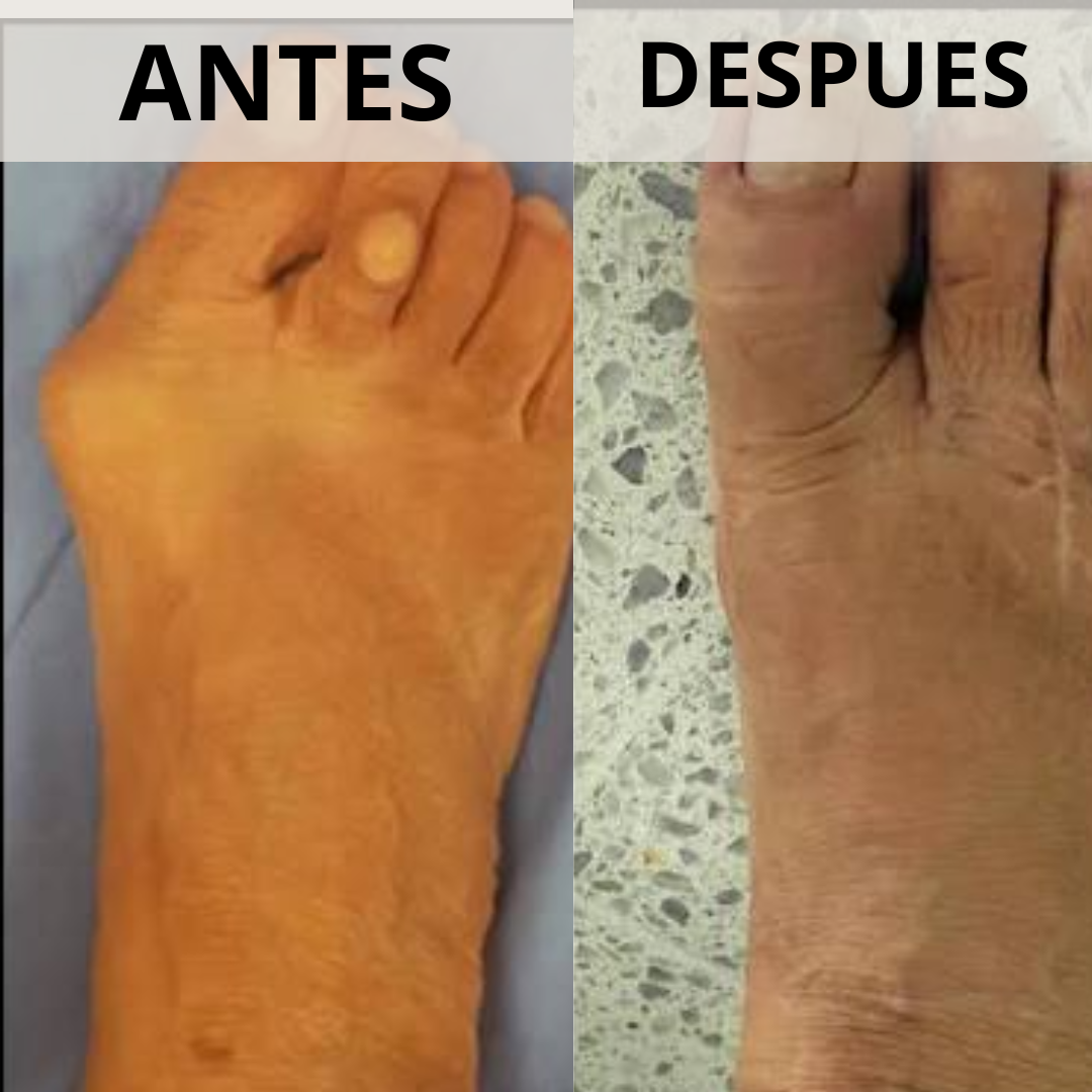 Corrector de Juanetes con perilla de ajuste